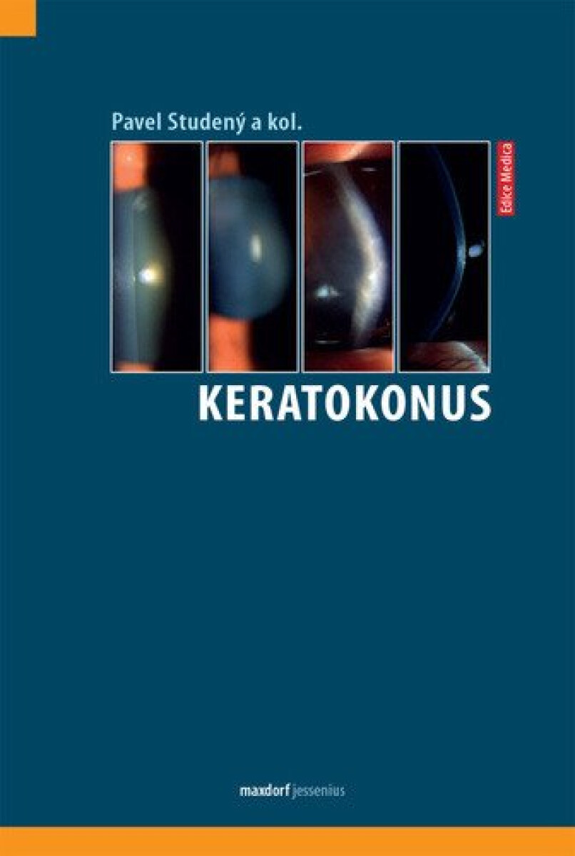Kniha Keratokonus