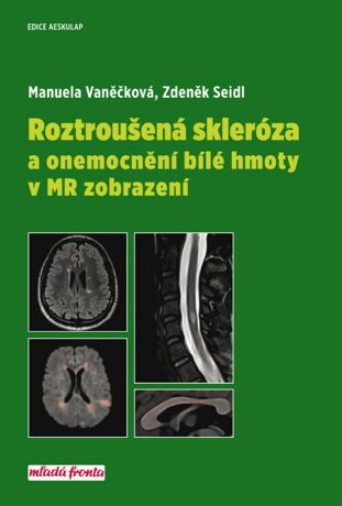Roztroušená skleróza a onemocnění bílé hmoty v MR zobrazení - Zdeněk Seidl,Manuela Vaněčková