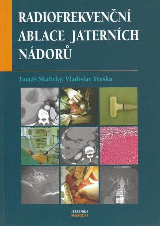 Radiofrekvenční ablace jaterních nádorů - Vladislav Třeška,Tomáš Skalický