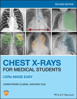 Chest X-Rays for Medical Students - Clarke Christopher,Anthony  Dux