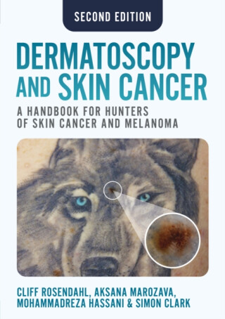 Dermatoscopy and Skin Cancer, second edition - Simon Clark,Aksana Marozava,Mohammadreza Hassani,Cliff Rosendahl