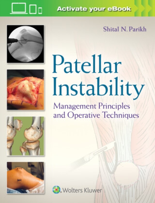 Patellar Instability - 