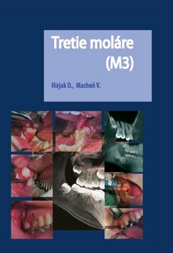 Tretie moláre (M3) - Vladimír Machoň,Dušan Hirjak