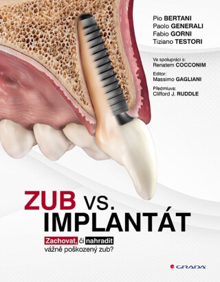 Zub vs. implantát - Bertani Pio,Generali Paolo,Gorni Fabio,Testori Tiziano